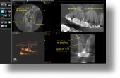 Endo-DVT